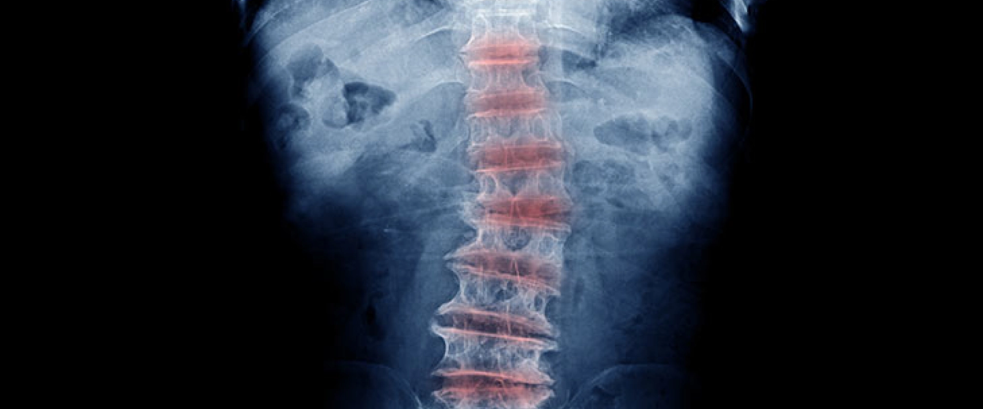Degenerative Disc Disease