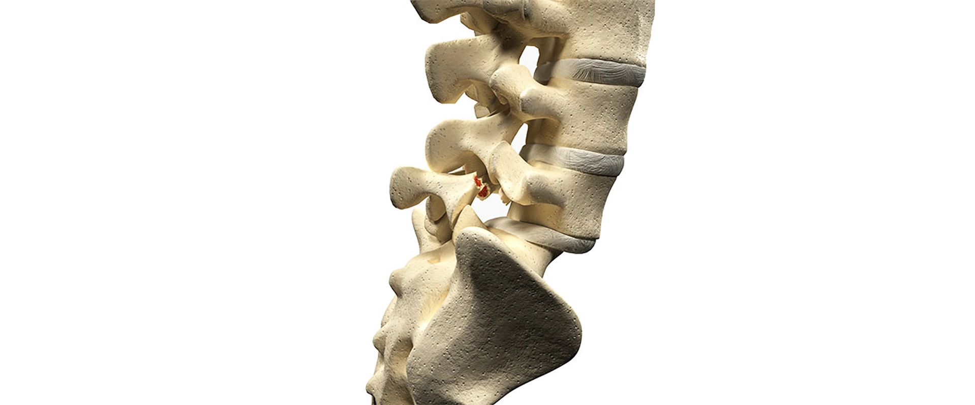 Spondylolisthesis