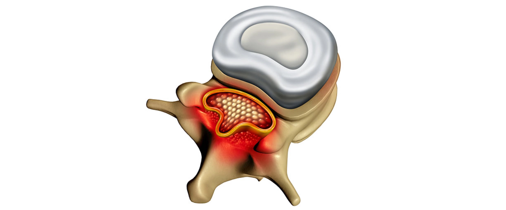 Spinal Stenosis