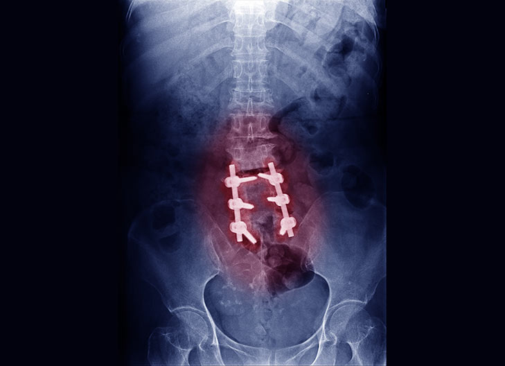 Artrodese Posterolateral