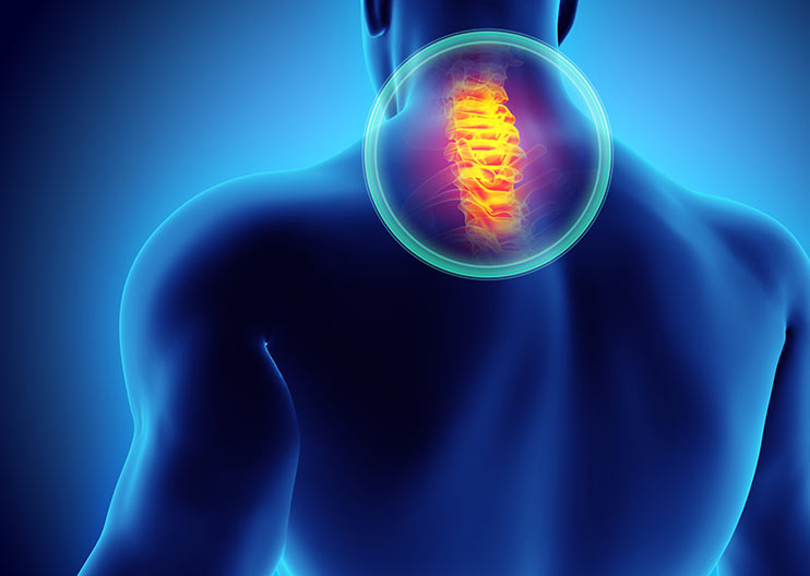 Laminoplastia Cervical